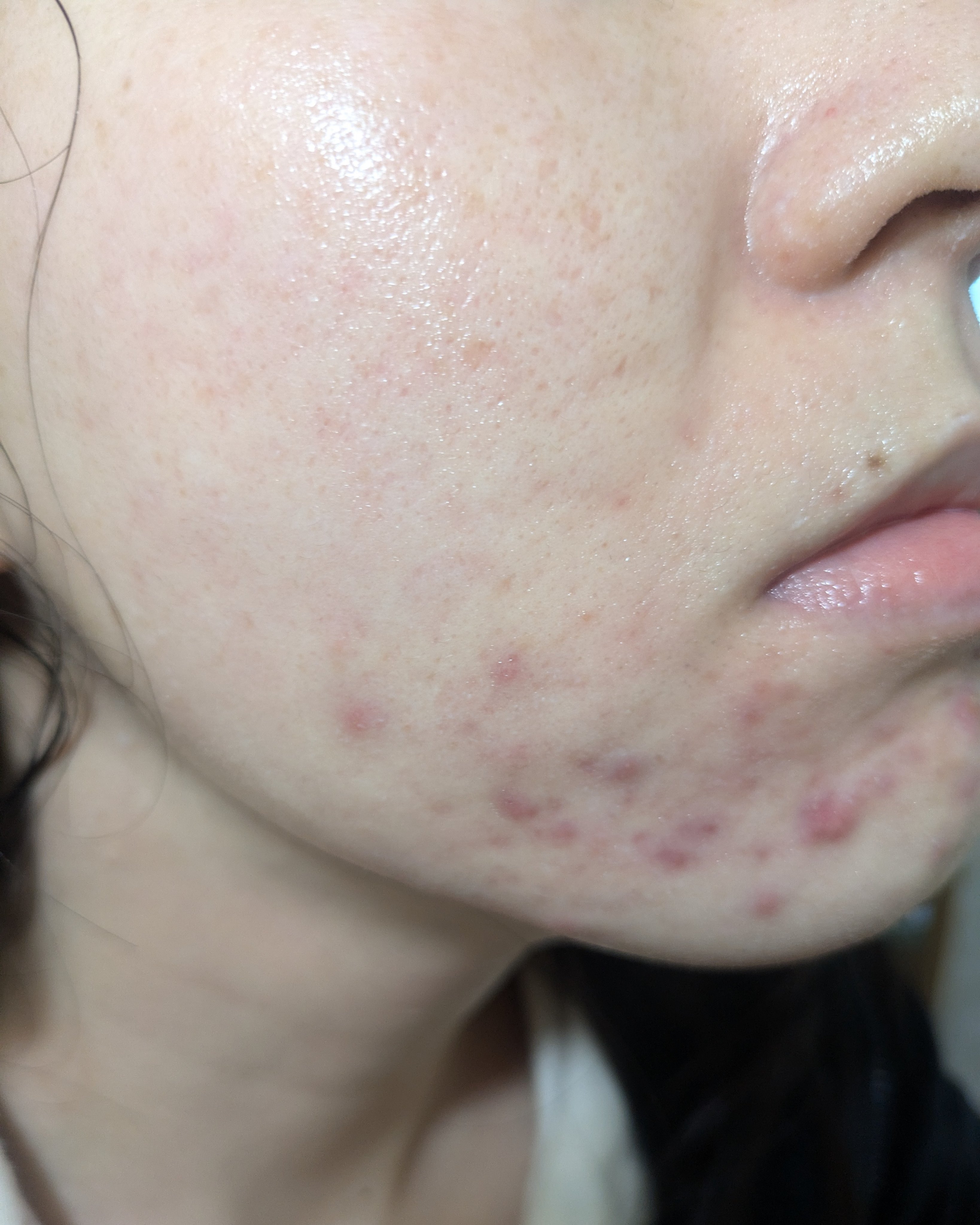 12/20の#汚肌工事録
🥲