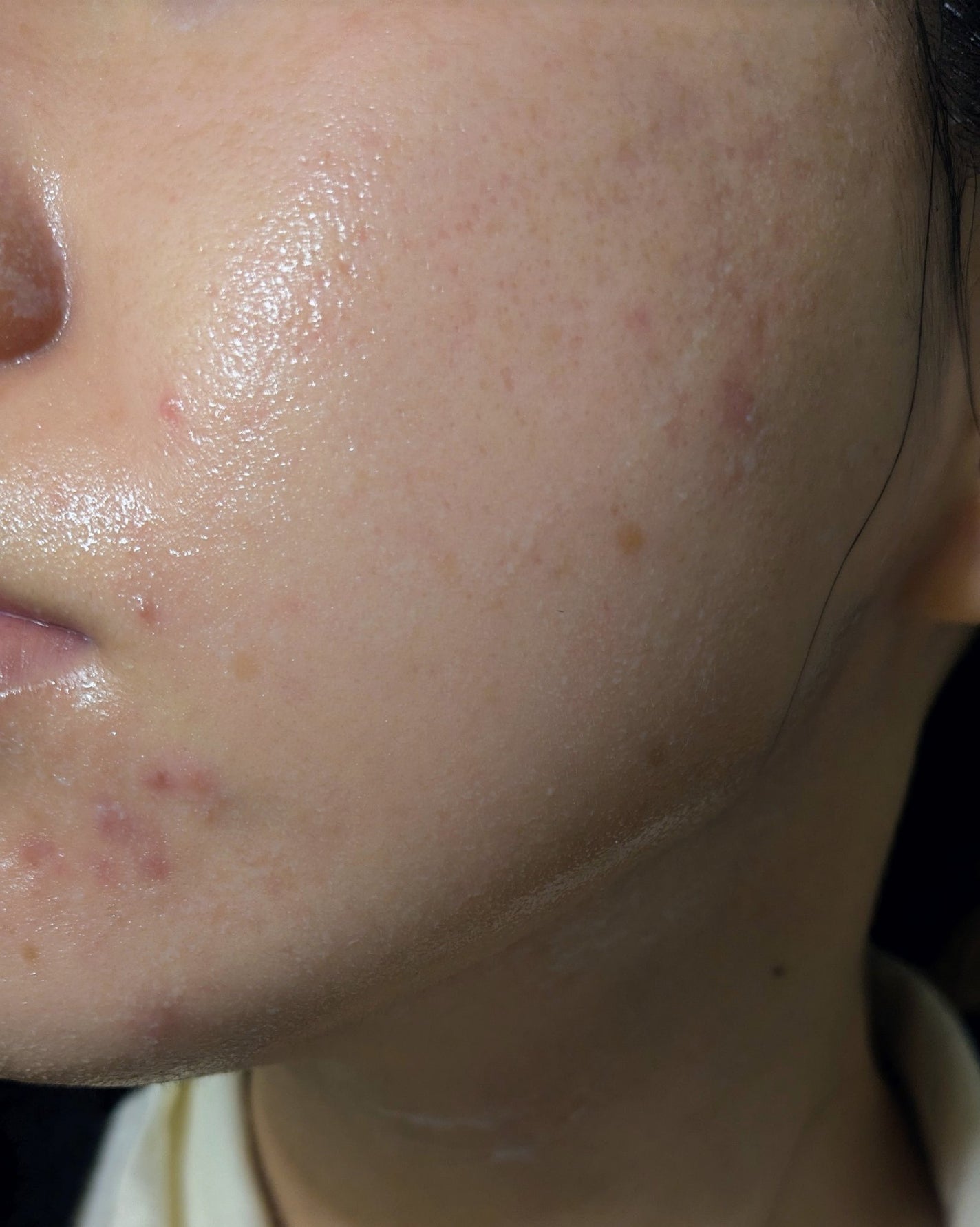 miina@汚肌工事録⚠️ on LIPS 「#汚肌工事録11月後半の写真。ボコボコしててホントに手が追えな..」(2枚目)