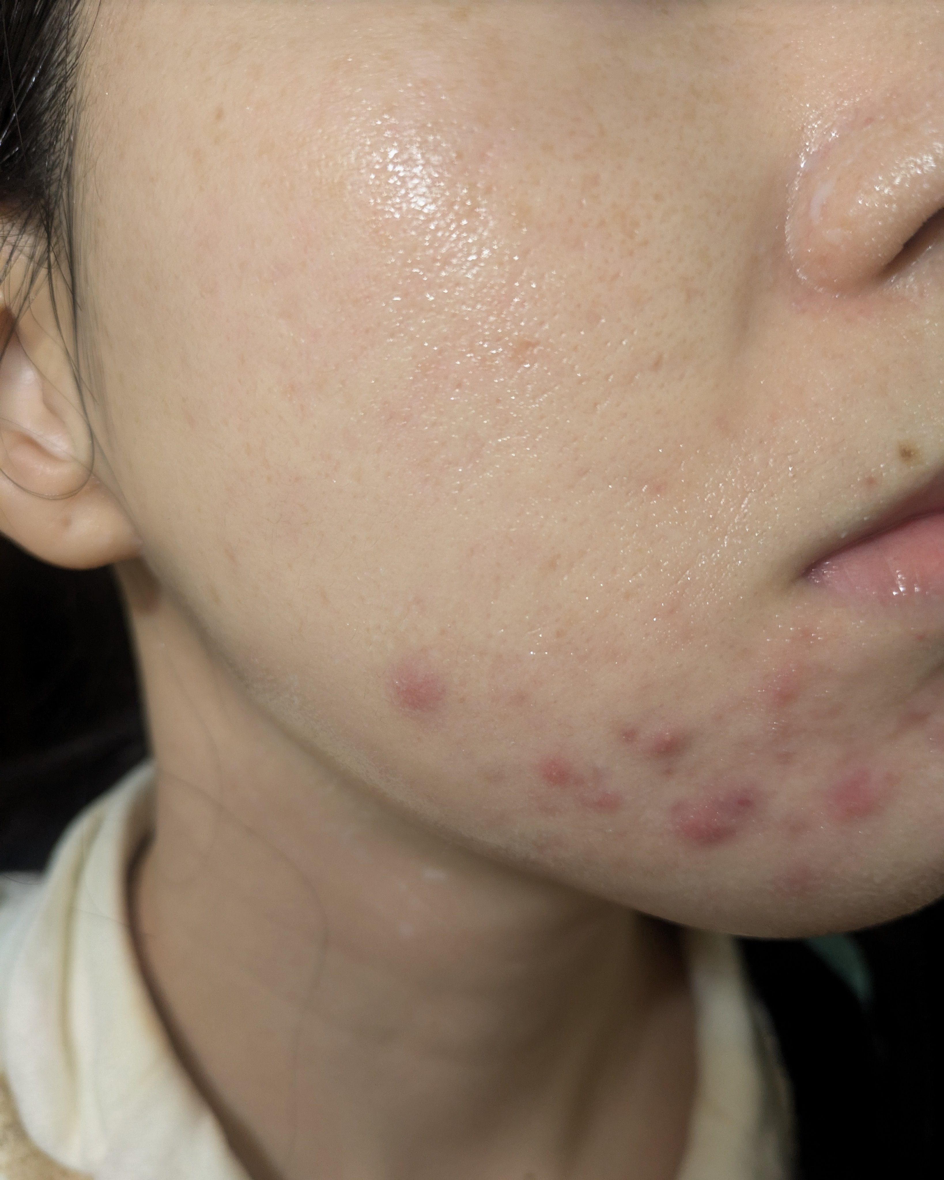 12/13-12/19の#汚肌工事録

どんどん赤くなってます😂

乾燥&マスクでダブルパンチだったと思います…