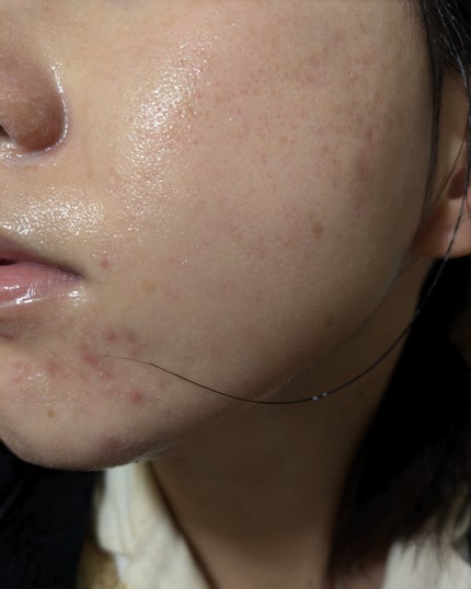 miina@汚肌工事録⚠️ on LIPS 「12/1-12/5の#汚肌工事録..」(8枚目)