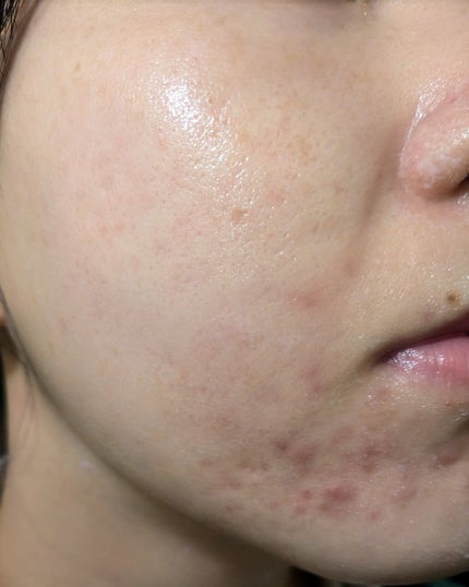 miina@汚肌工事録⚠️ on LIPS 「#汚肌工事録11月後半の写真。ボコボコしててホントに手が追えな..」(3枚目)