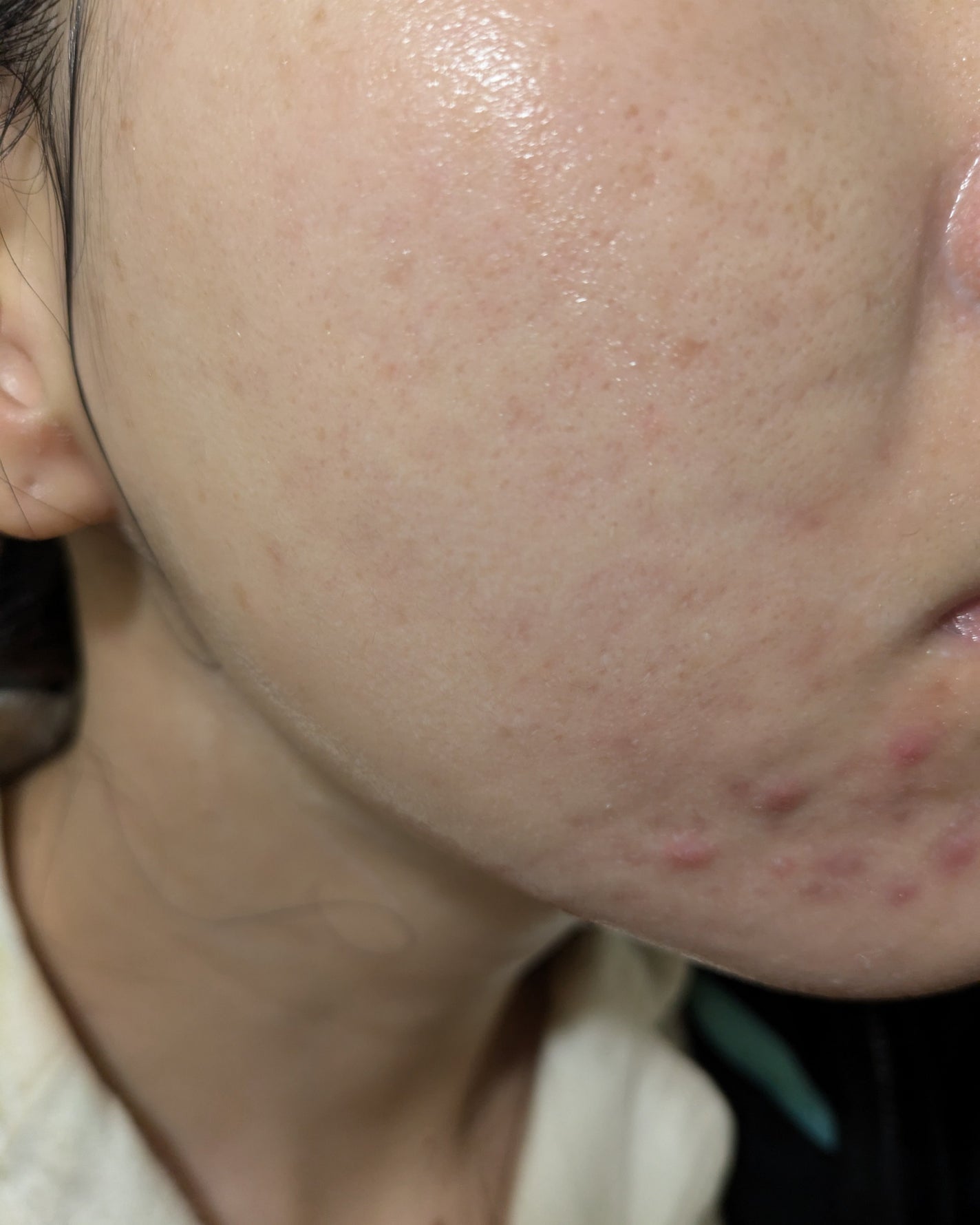 miina@汚肌工事録⚠️ on LIPS 「12/1-12/5の#汚肌工事録..」(7枚目)