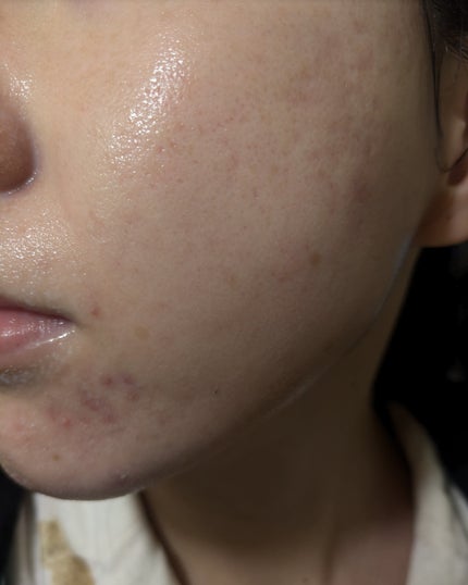 miina@汚肌工事録⚠️ on LIPS 「12/1-12/5の#汚肌工事録..」(2枚目)