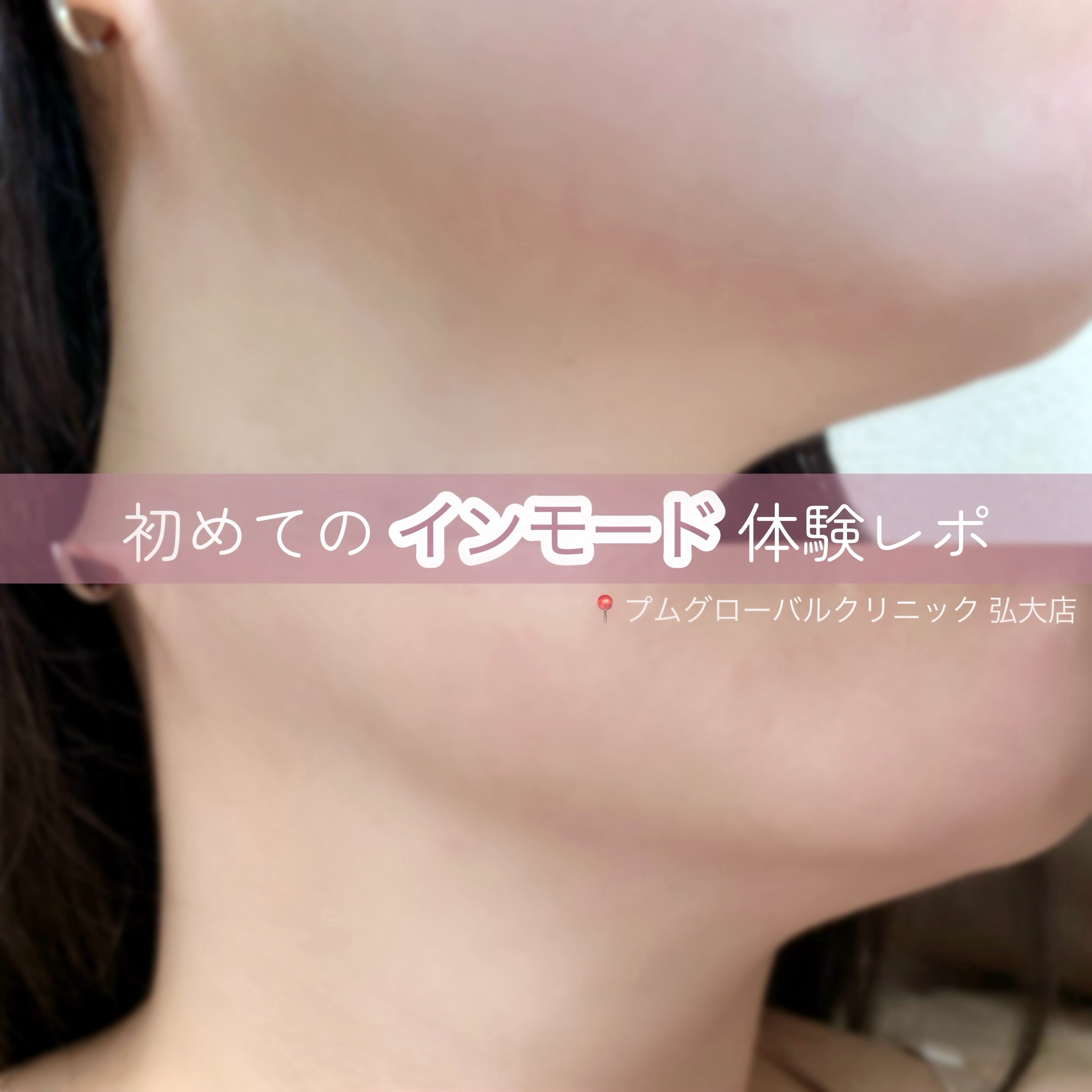 1人旅in韓国美容①

📍プムグローバルクリニック 弘大店🇰🇷


インモード（一部位）を施術しました🌟

結果から言えば、脂肪多め丸顔の私には効果を感じられて大満足！

ちなみに体重は渡韓前と渡韓後で全く変わってないんだけど、
フ