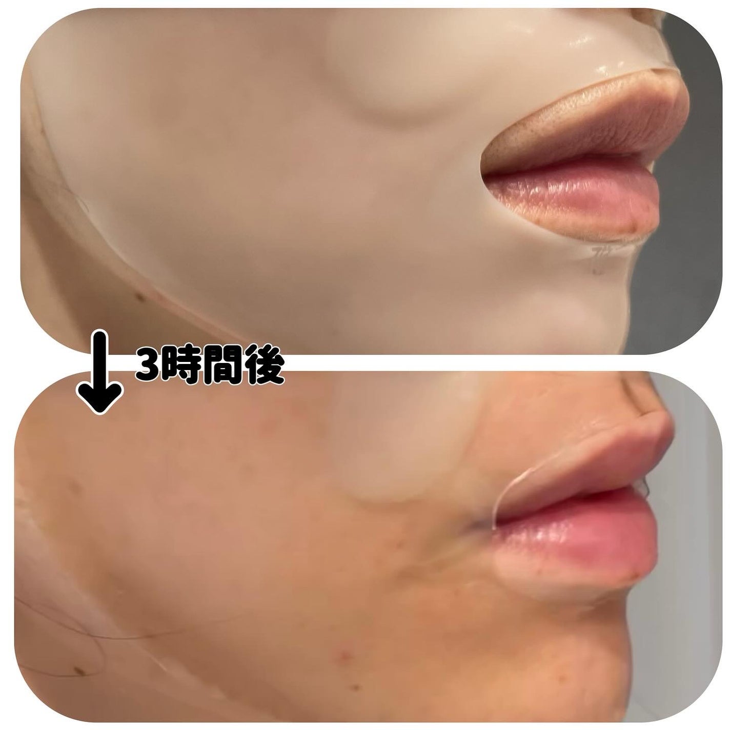 RXザ・アルファアルブチン2 ニキビ跡ケアセラム/COSRX/美容液を使ったクチコミ(5枚目)