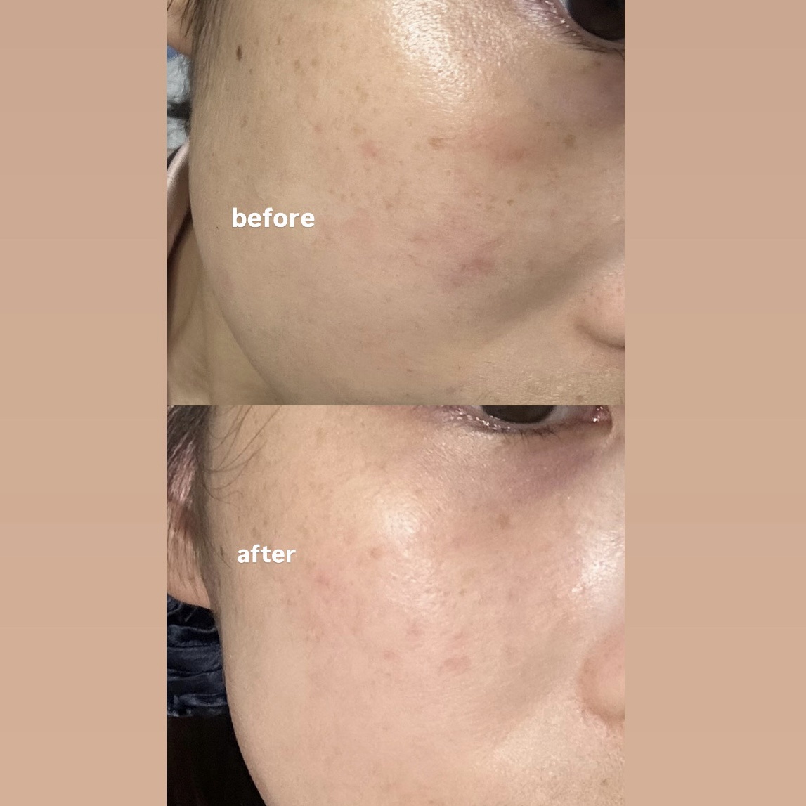 ビタ3セラム/オーズナリー/美容液を使ったクチコミ（1枚目）