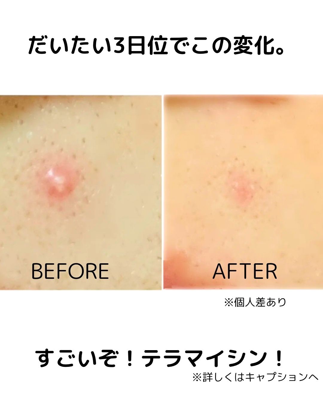 テラマイシン 軟膏(医薬品)/ジョンソン・エンド・ジョンソン/その他を使ったクチコミ（3枚目）