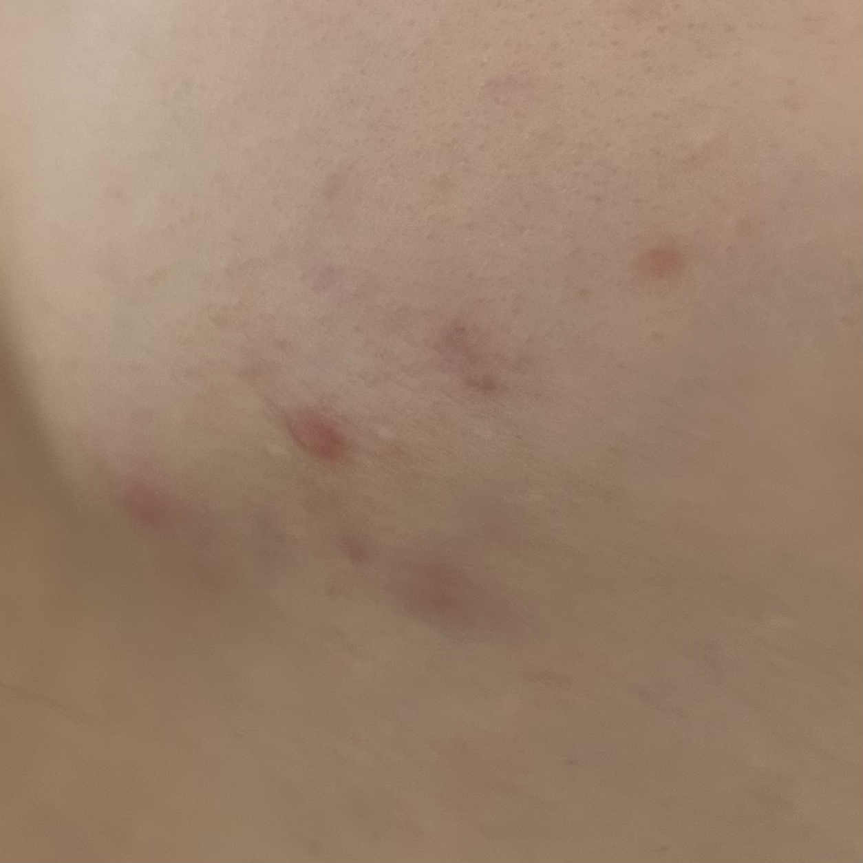 CICA TEATREE 5X SPOT/G9SKIN/その他スキンケアを使ったクチコミ（3枚目）