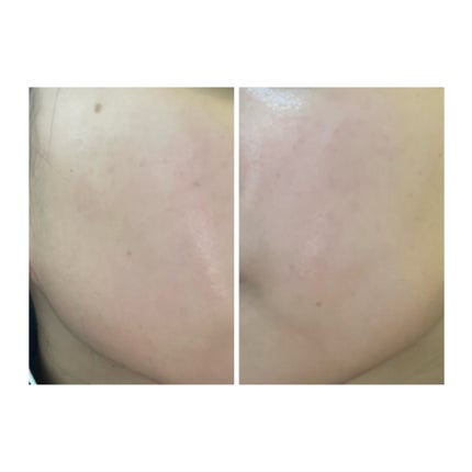 ぽむ on LIPS 「2023.9.13皮膚科に受診 エピデュオとヘパリン処方1枚目..」(4枚目)