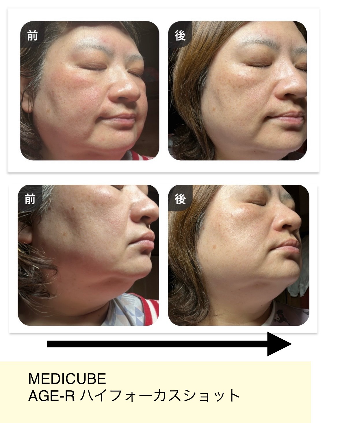 試してみた】AGE-R ハイフォーカスショット MEDICUBEのリアルな
