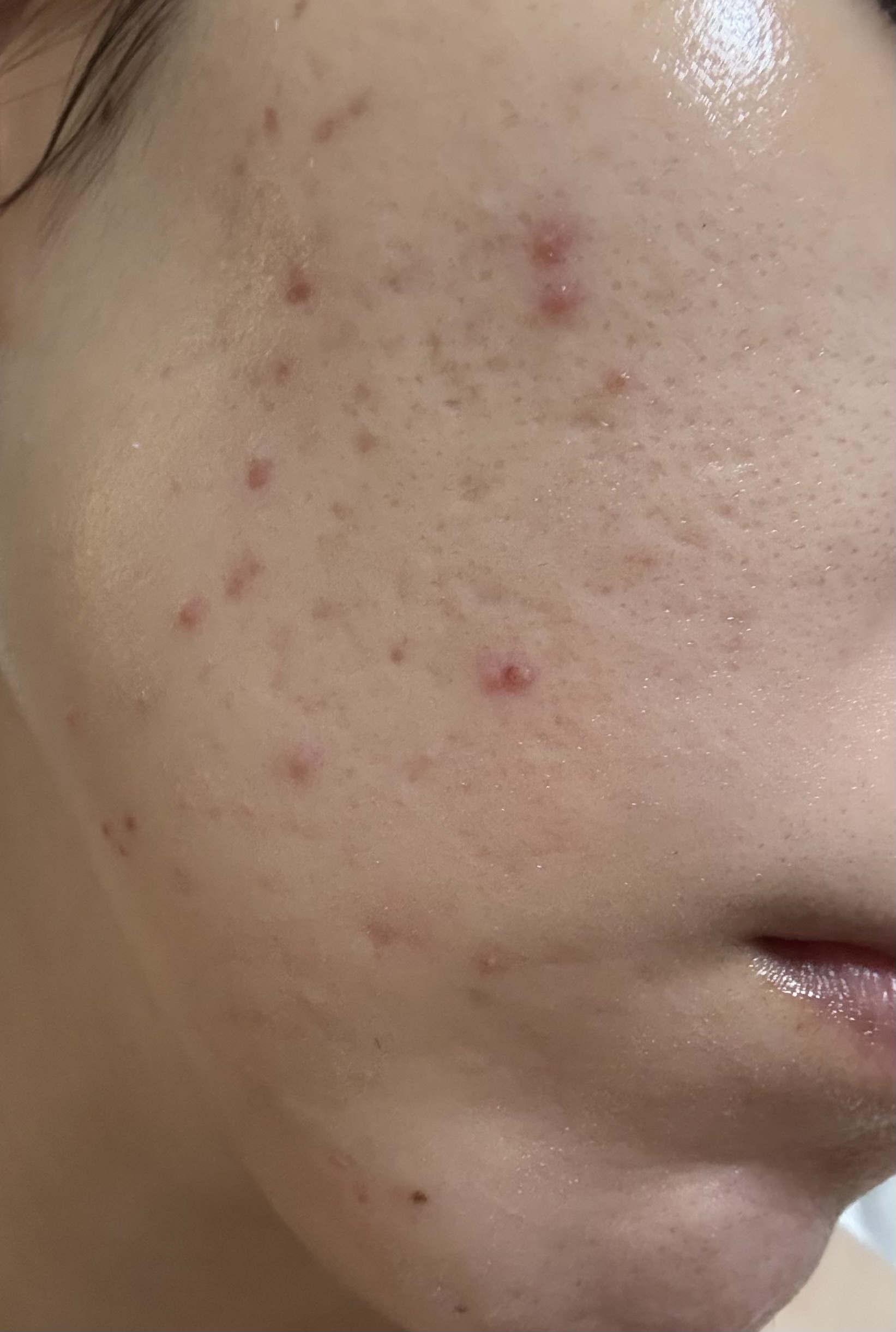 潤浸保湿 化粧水 III とてもしっとり/キュレル/化粧水を使ったクチコミ（2枚目）