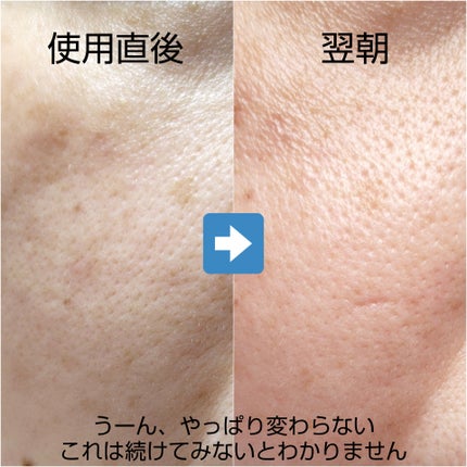 ダーマレーザースペクター ウルセラCMAX/クオリティファースト/美容液を使ったクチコミ(4枚目)