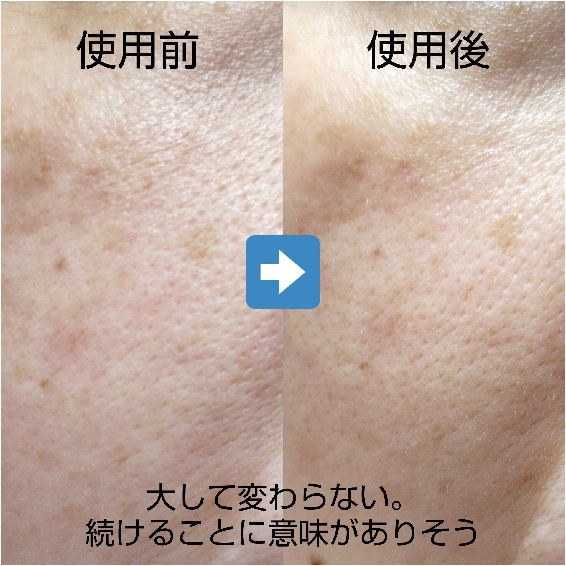 ダーマレーザースペクター ウルセラCMAX/クオリティファースト/美容液を使ったクチコミ（3枚目）