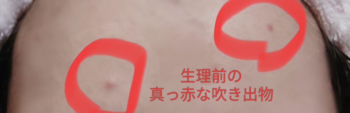 ティーツリーカーミングスポットパッチ/MEDIHEAL/その他スキンケアを使ったクチコミ(5枚目)