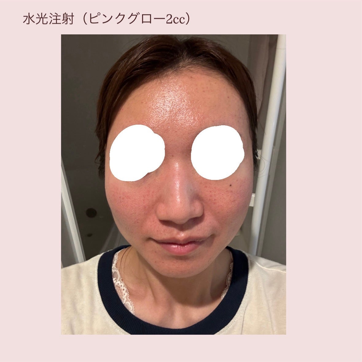 お芋ちゃん|10年以上ニキビに悩む保育士 on LIPS 「トライフィルプロは1回で4万したから、継続が難しかった💦美容医..」(4枚目)