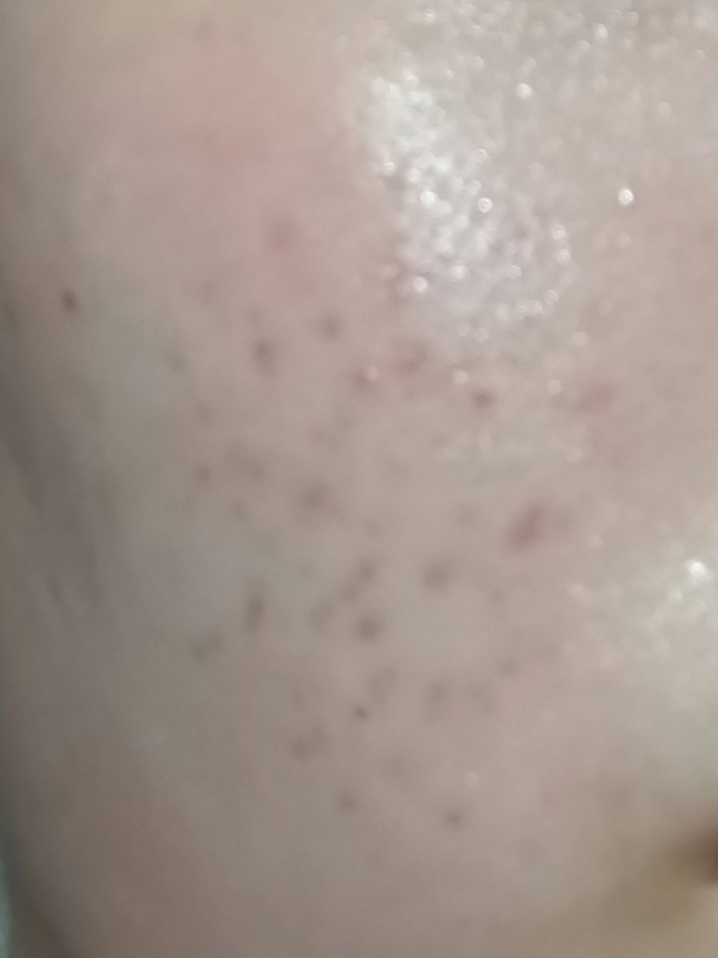 いぬ✢フォロバ100✢ on LIPS 「自分用記録デュアック20日目ニキビは治まったけど、ニキビ跡がや..」(1枚目)