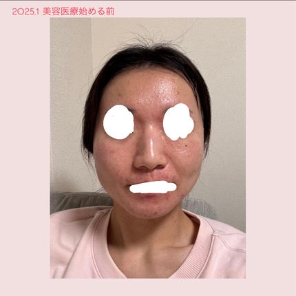 お芋ちゃん|10年以上ニキビに悩む保育士 on LIPS 「トライフィルプロは1回で4万したから、継続が難しかった💦美容医..」(6枚目)