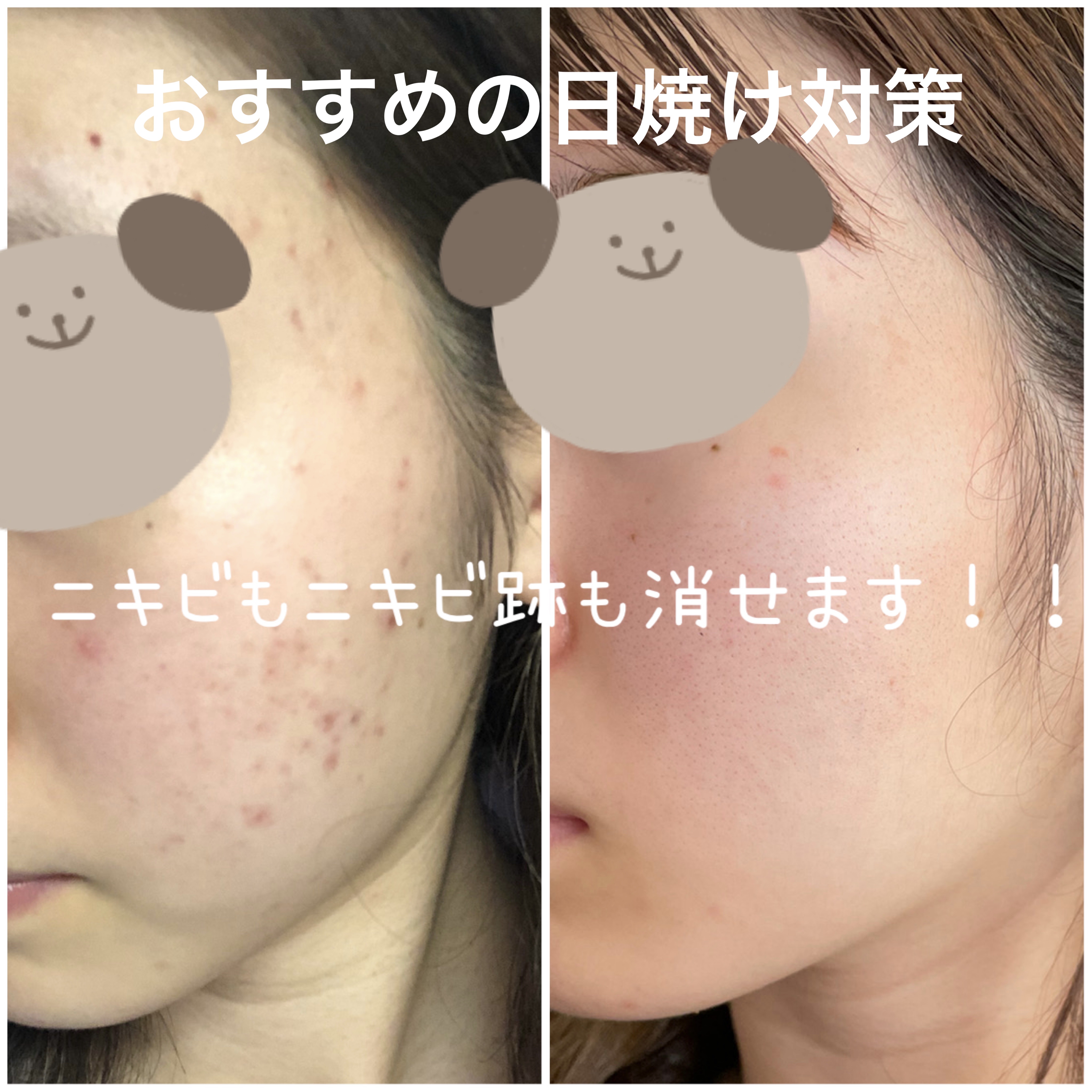 アクメディカ　薬用　UVミルク/ナリスアップ/日焼け止めミルクを使ったクチコミ（1枚目）