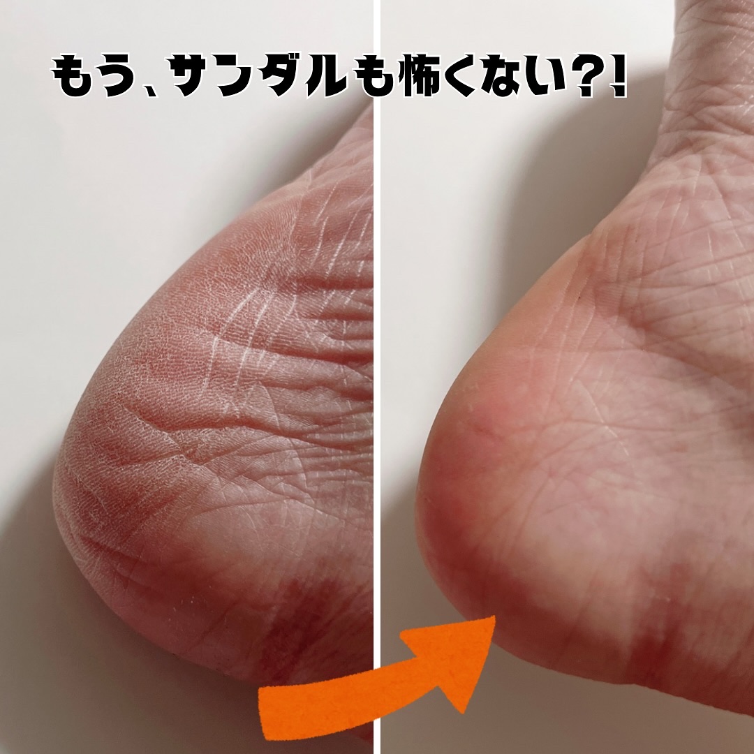 フットケアセット/BAREN/その他キットセットを使ったクチコミ（3枚目）