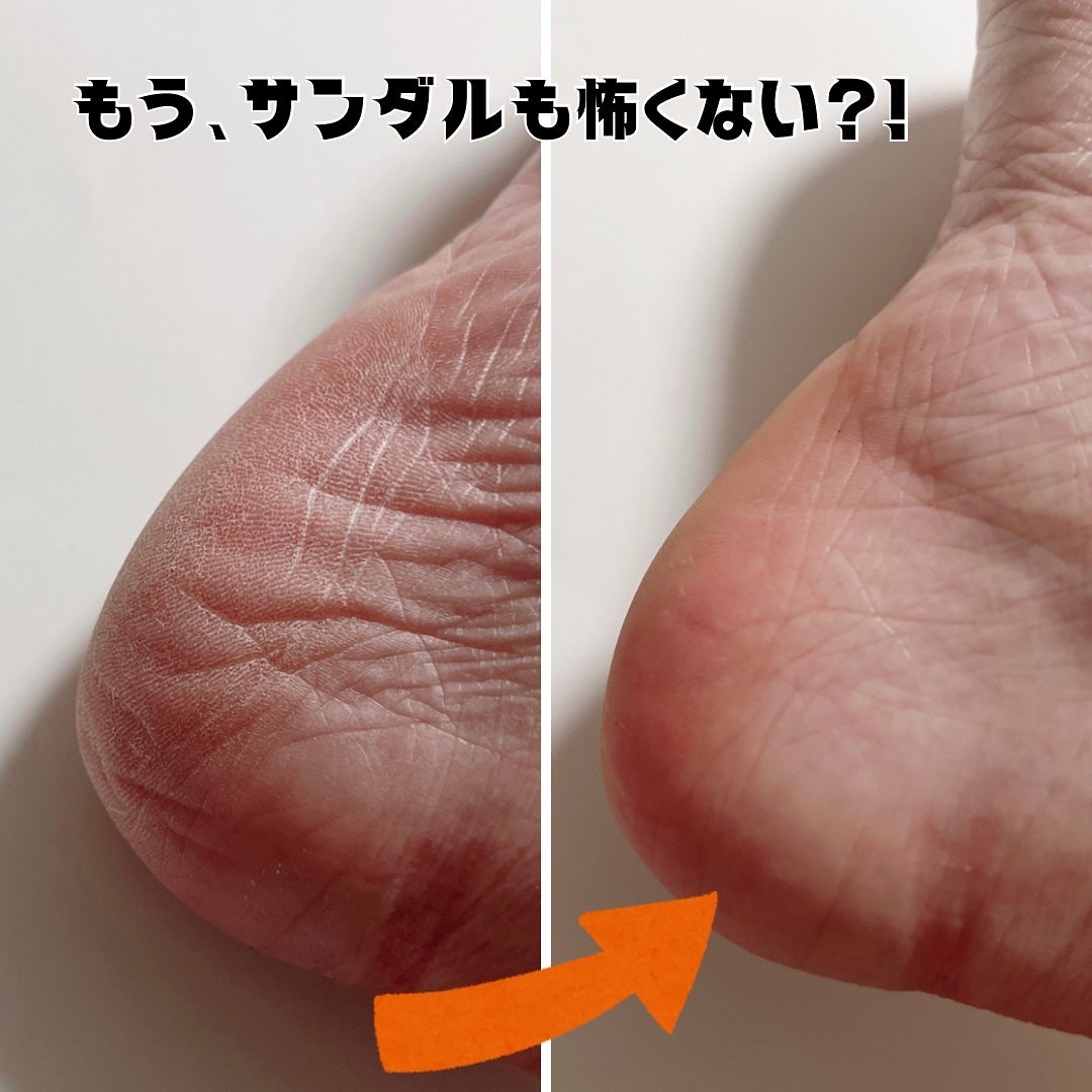 フットケアセット/BAREN/その他キットセットを使ったクチコミ(3枚目)