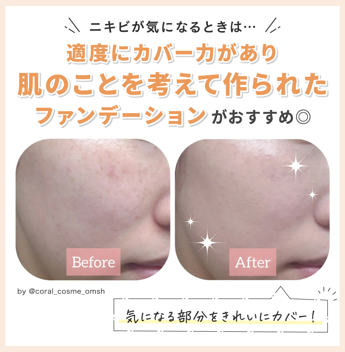 ニキビが気になるときは適度にカバー力があり肌のことを考えて作られたファンデーションがおすすめ◎気になる部分をきれいにカバー！