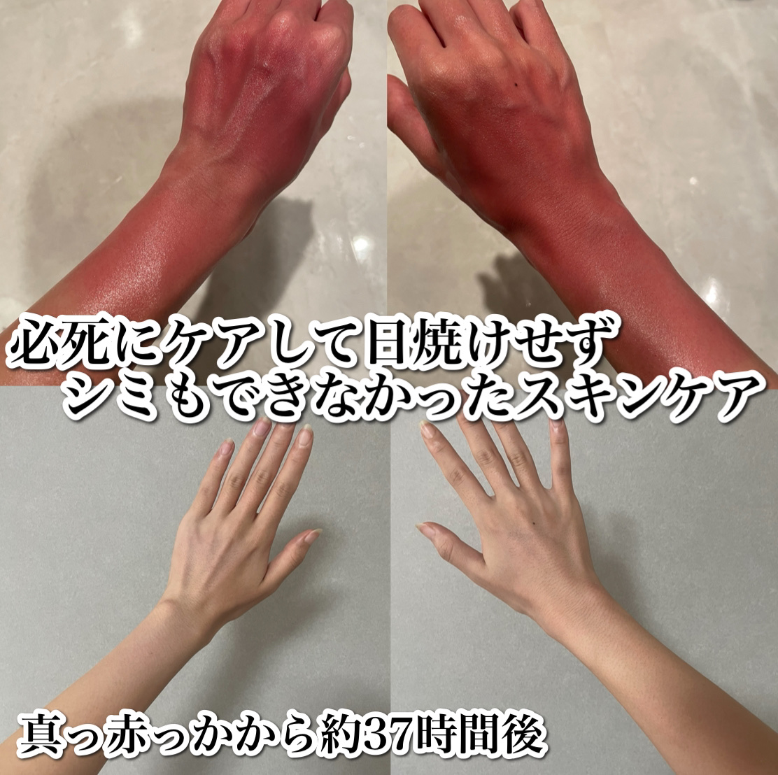 

真っ赤に日焼けした時の私のケア方法☀️


去年の7月プールに行き
彼氏も私もラッシュカードを着て
2人とも日焼け止めも何回も塗り直した結果
彼氏も私も全く同じ日焼けの仕方で
なんとか37時間後には赤みがなくなり
日焼けもせず、シミもで