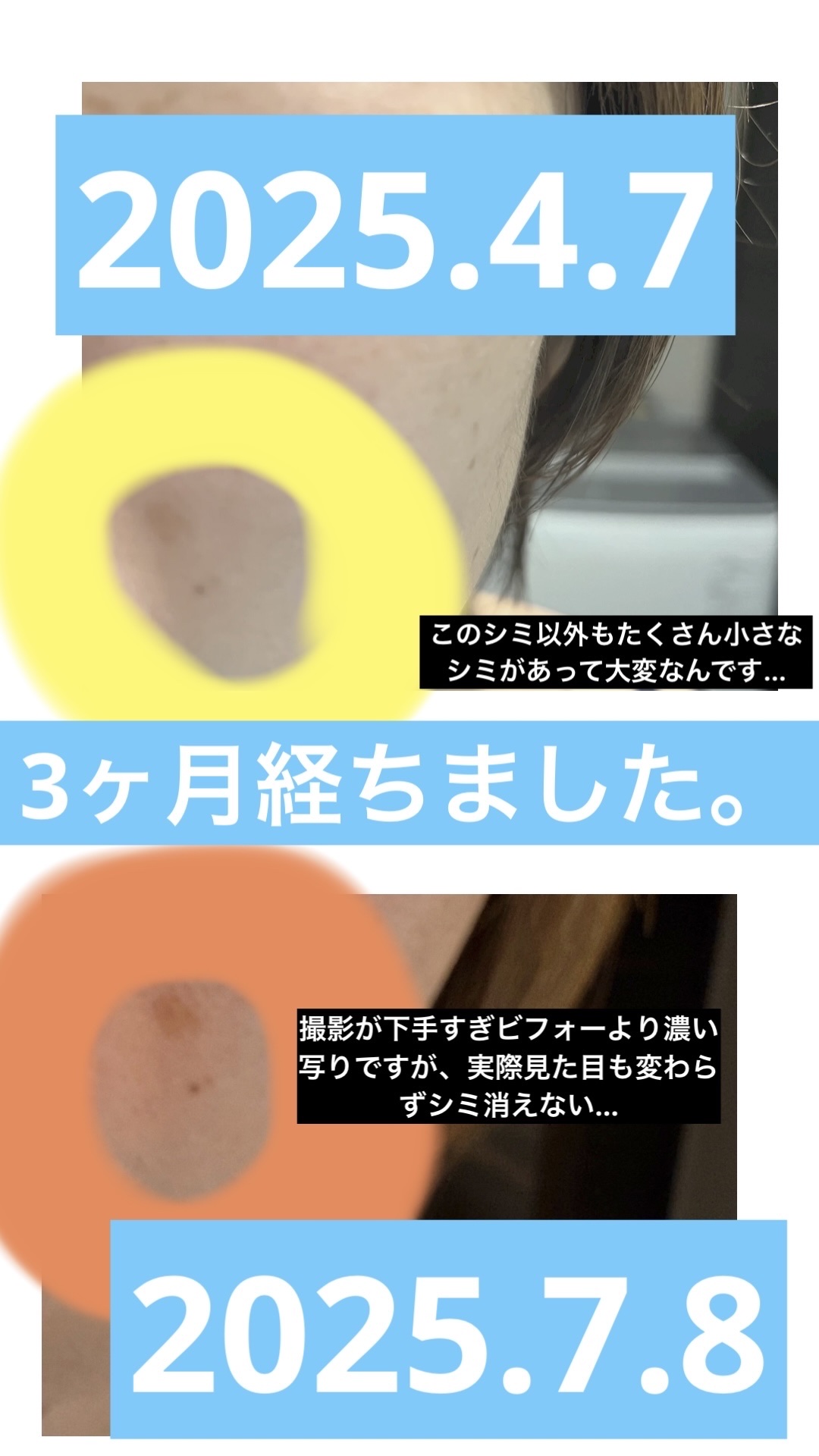 レディブラン 薬用美白シミキールパックC/シーヴァ/ピーリングを使ったクチコミ（2枚目）