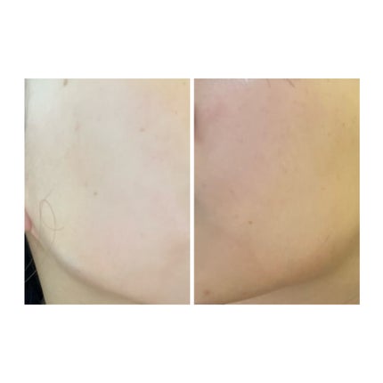 ぽむ on LIPS 「2023.9.13皮膚科に受診 エピデュオとヘパリン処方1枚目..」(4枚目)