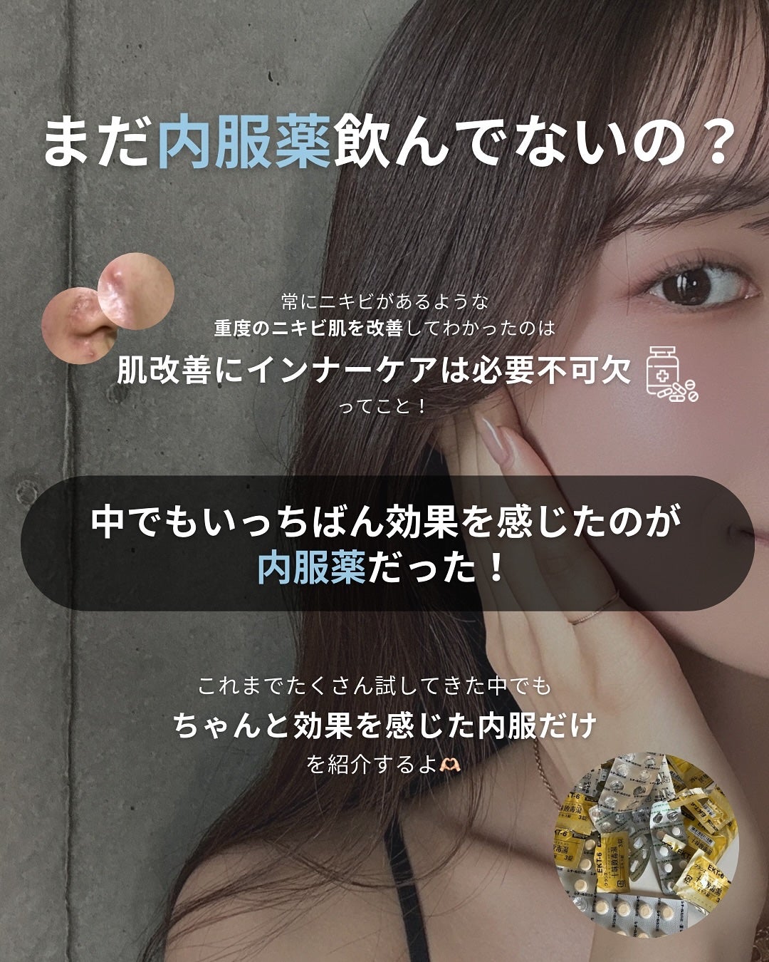 白湯(サユ) | ニキビと戦うOL🤍 on LIPS 「・白湯です🫶🏻今日はニキビ改善に一番効果を感じた「内服薬」につ..」(2枚目)