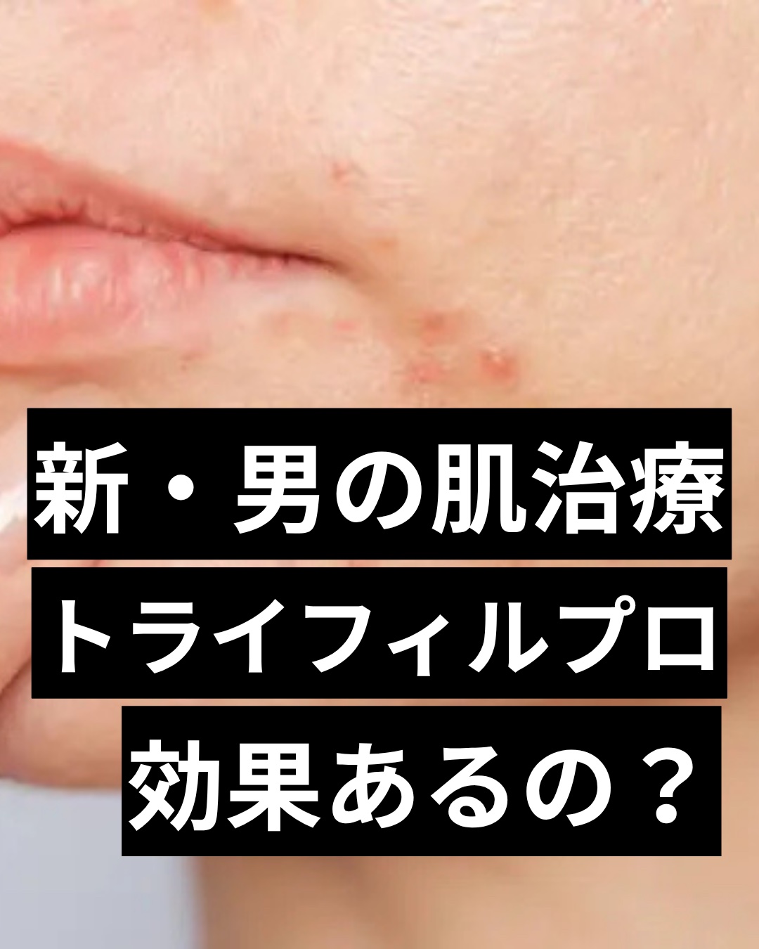 #トライフィルプロ #美容医療　