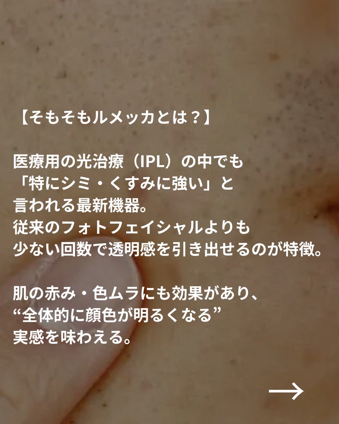 美容ニキ@美容ラボ on LIPS 「#ルメッカ#美容医療#シミケア..」(2枚目)