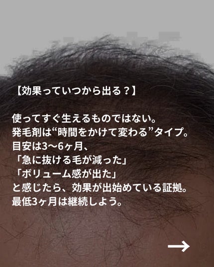 美容ニキ@美容ラボ on LIPS 「#発毛剤#育毛剤#ヘアケア ..」(6枚目)