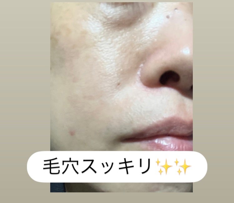 弱酸性毛穴収縮ニドソープ/ODELOI/その他洗顔料を使ったクチコミ(7枚目)