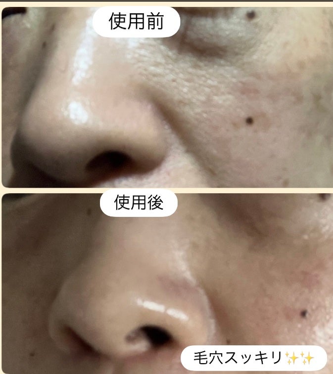 弱酸性毛穴収縮ニドソープ/ODELOI/その他洗顔料を使ったクチコミ(6枚目)