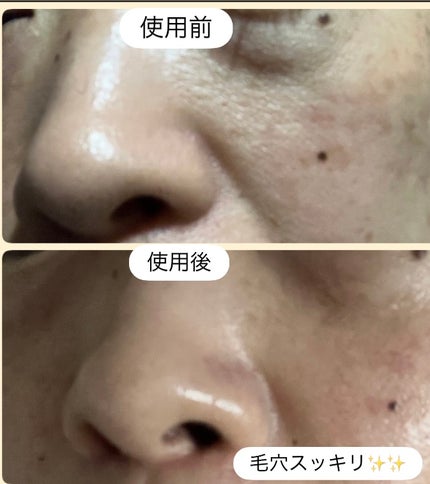 弱酸性毛穴収縮ニドソープ/ODELOI/その他洗顔料を使ったクチコミ(6枚目)