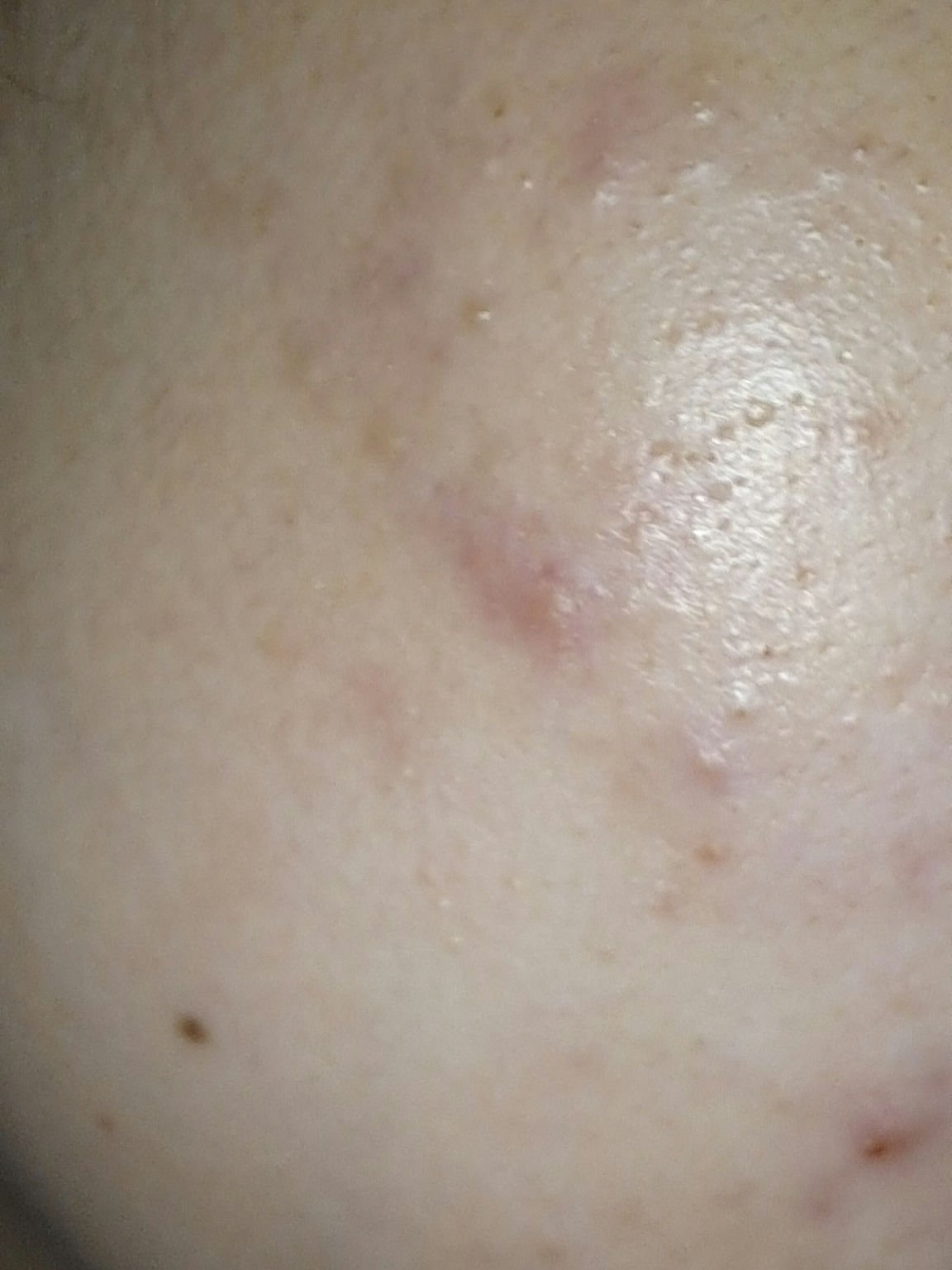 ペアアクネクリームW(医薬品)/ペア/その他を使ったクチコミ（1枚目）