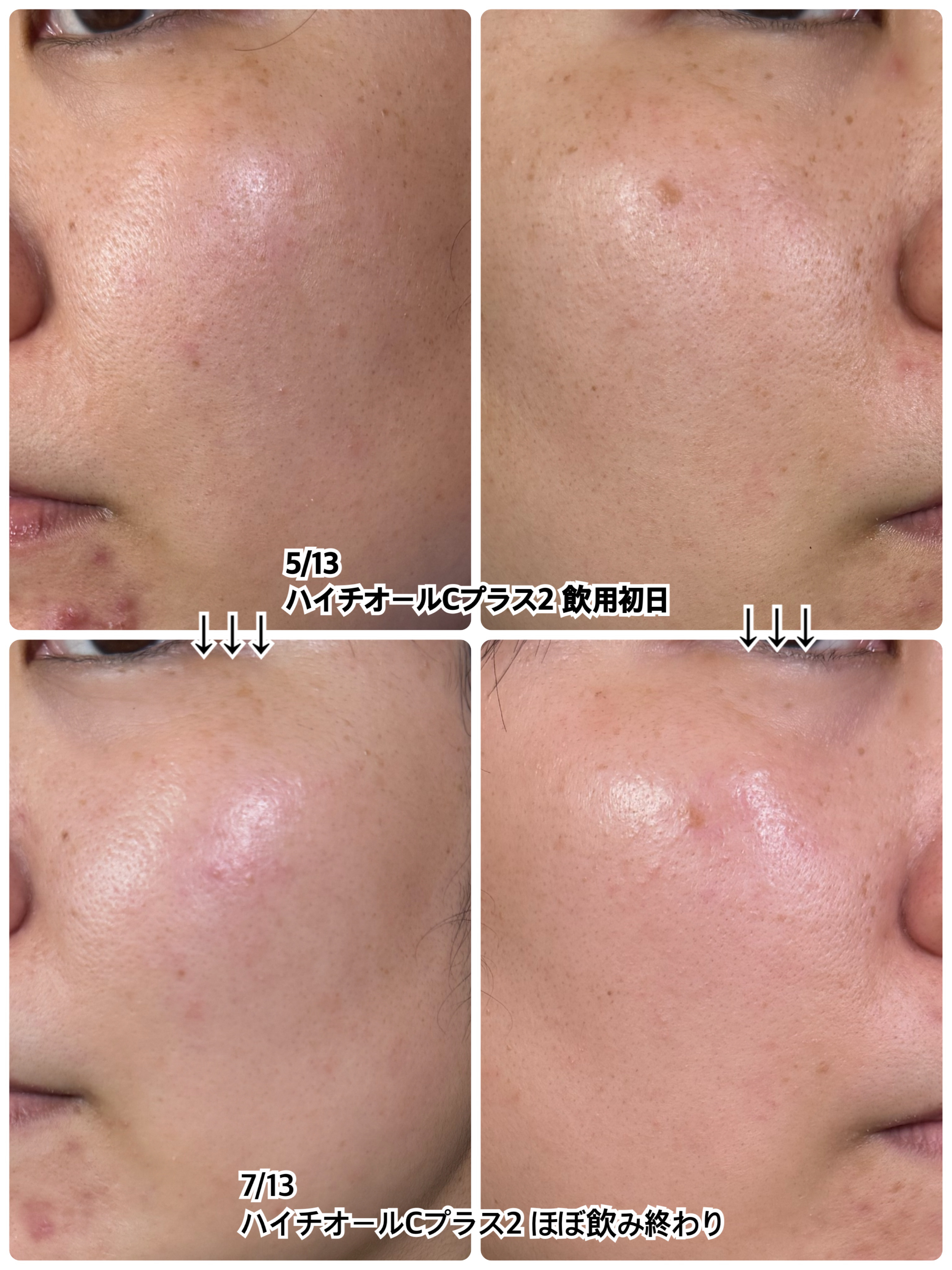 ハイチオールCプラス2(医薬品)/エスエス製薬/その他を使ったクチコミ（2枚目）