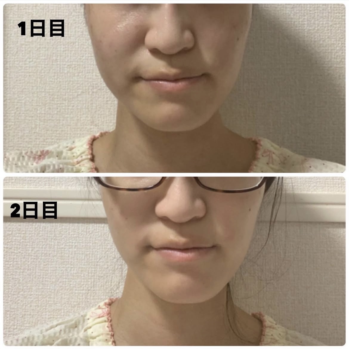 ReFa CARAT/ReFa/ボディケア美容家電を使ったクチコミ（2枚目）