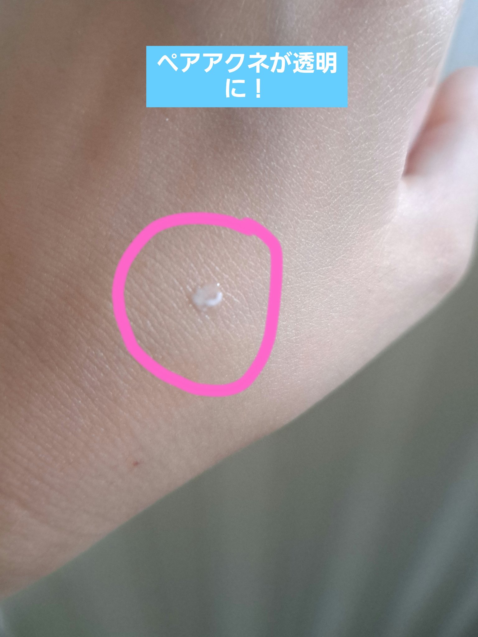 ペアアクネクリームW(医薬品)/ペア/その他を使ったクチコミ（3枚目）