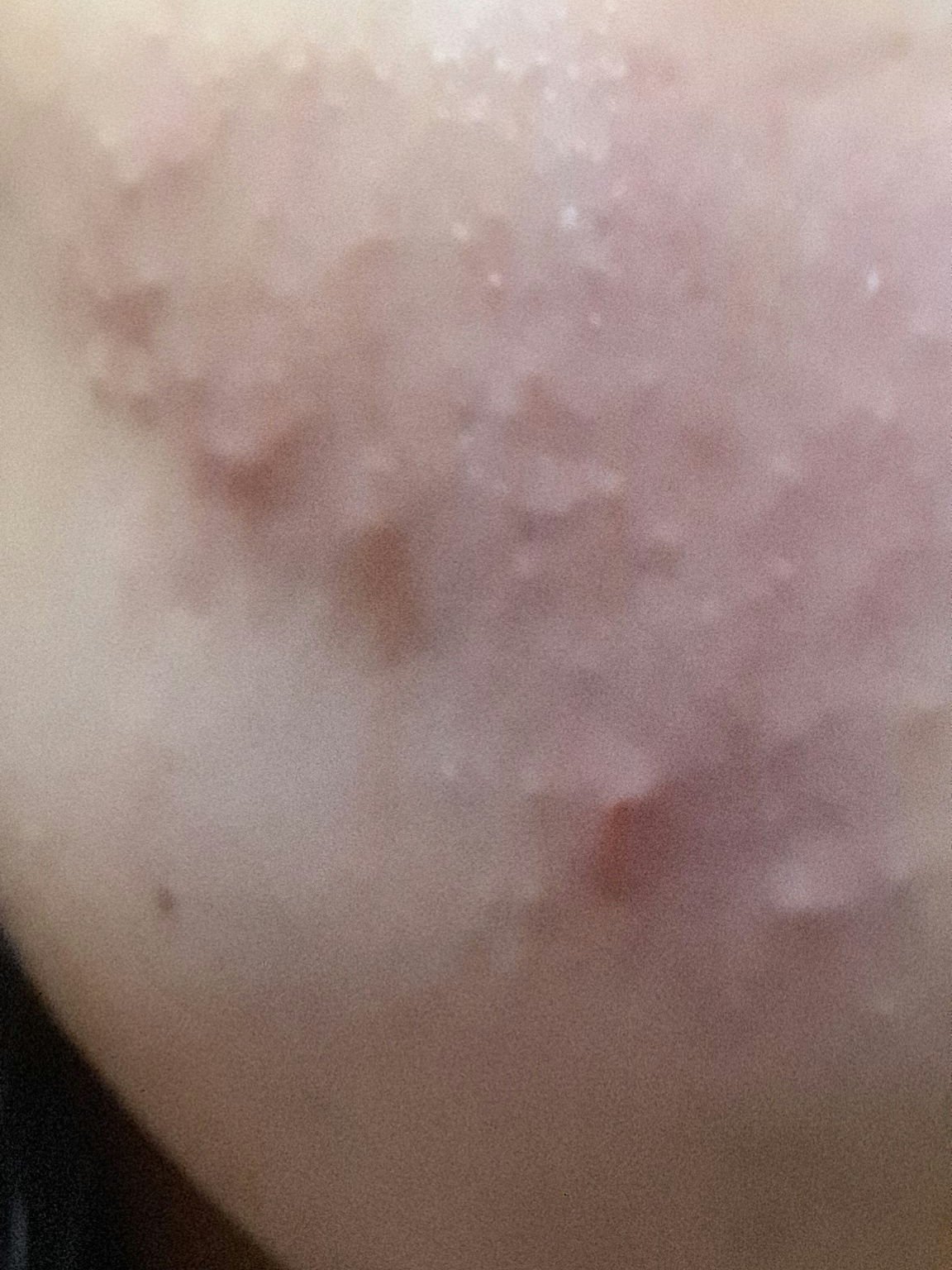 ペアアクネクリームW(医薬品)/ペア/その他を使ったクチコミ（1枚目）