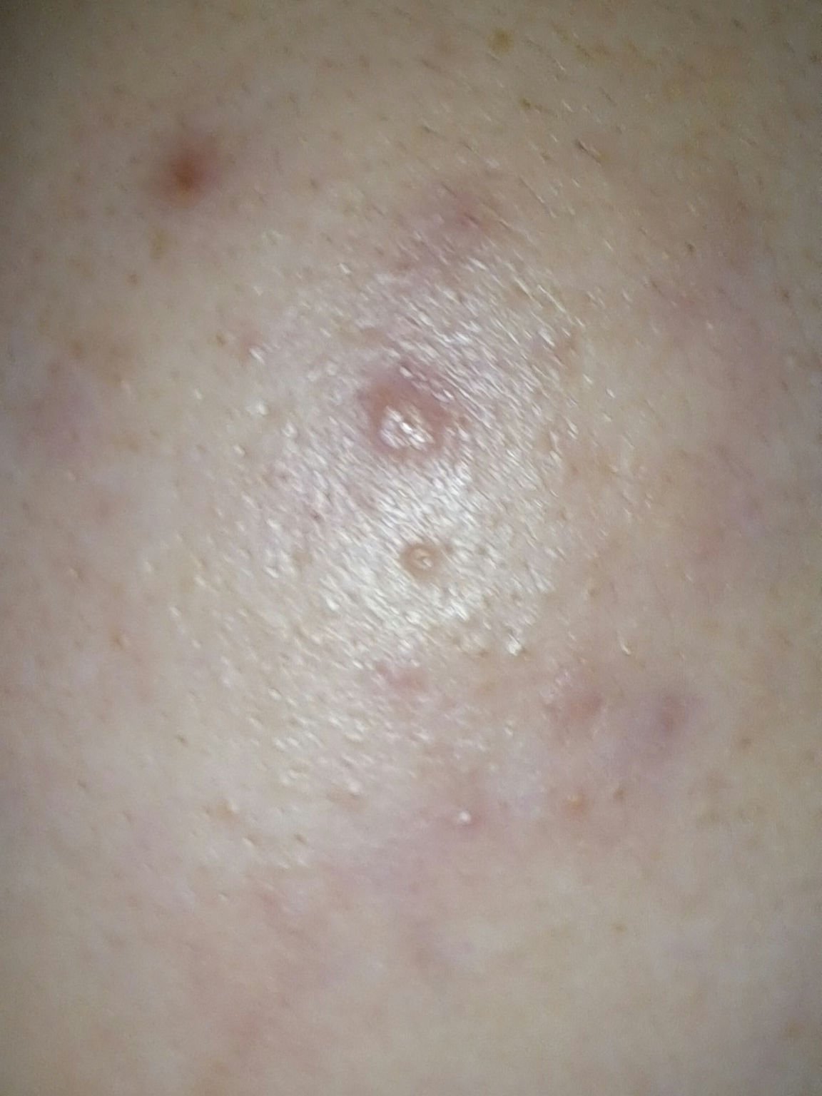 ペアアクネクリームW(医薬品)/ペア/その他を使ったクチコミ（2枚目）