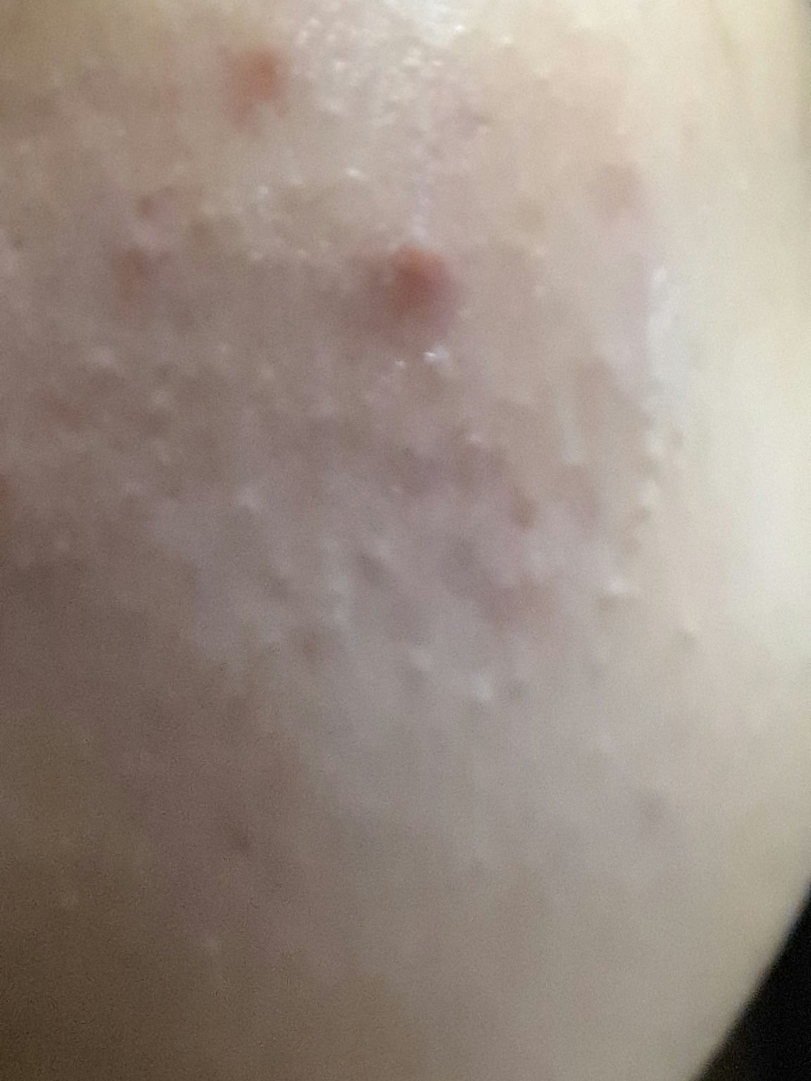 ペアアクネクリームW(医薬品)/ペア/その他を使ったクチコミ（2枚目）