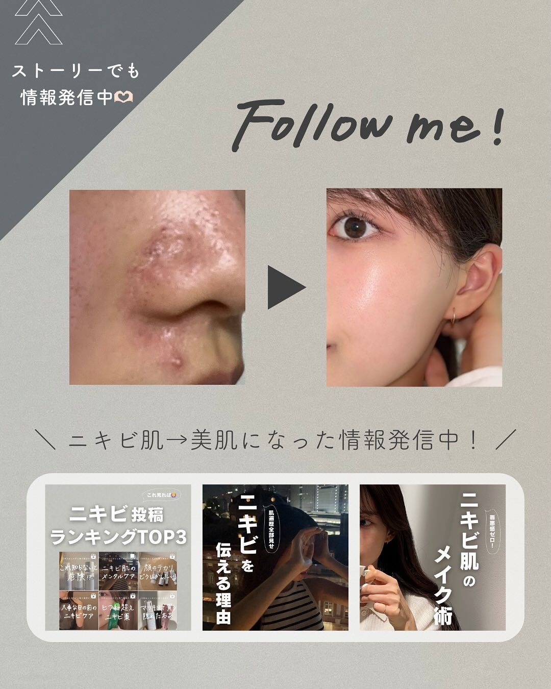 白湯(サユ) | ニキビと戦うOL🤍 on LIPS 「・白湯です🫶🏻ニキビ跡って全然消えなくない?泣ニキビできるのも..」(9枚目)