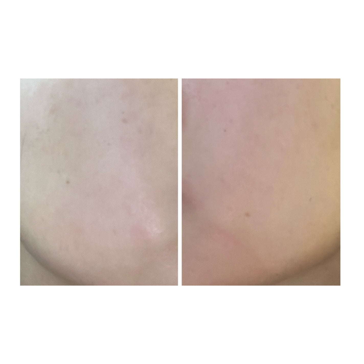 ぽむ on LIPS 「2023.9.13皮膚科に受診 エピデュオとヘパリン処方1枚目..」(4枚目)