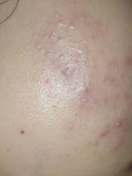 アポスティークリーム(医薬品)/アポスティー/その他を使ったクチコミ（1枚目）