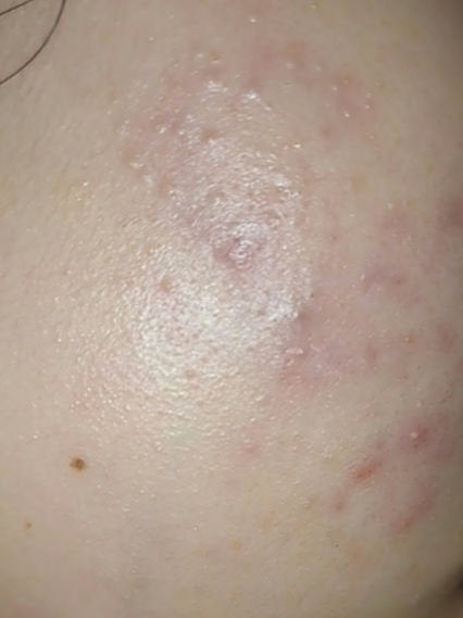 アポスティークリーム(医薬品)/アポスティー/その他を使ったクチコミ(1枚目)