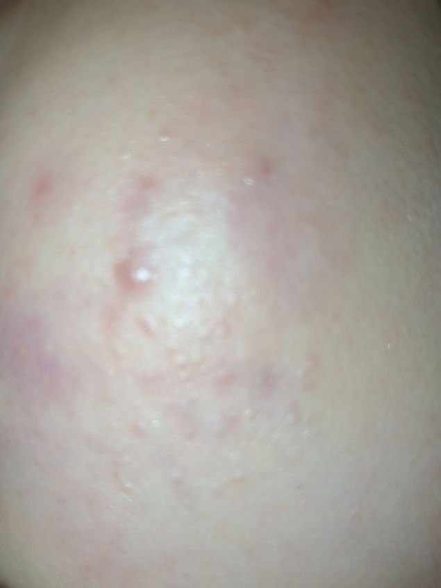 アポスティークリーム(医薬品)/アポスティー/その他を使ったクチコミ（2枚目）