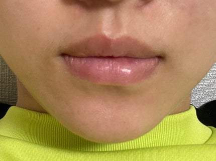 リードルS リッププランパーエキスパート/VT/リッププランパーを使ったクチコミ(3枚目)