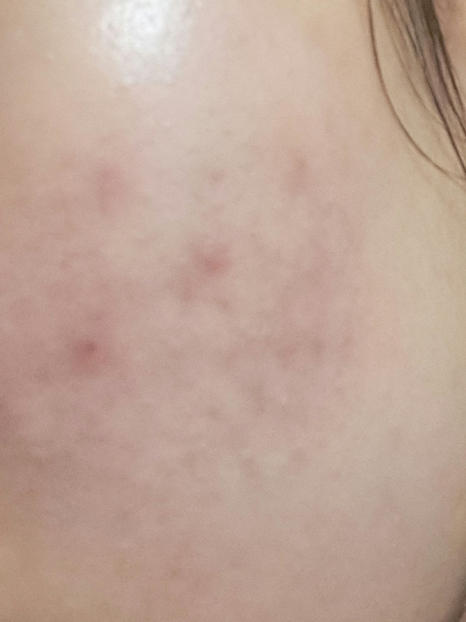 アポスティークリーム(医薬品)/アポスティー/その他を使ったクチコミ（2枚目）