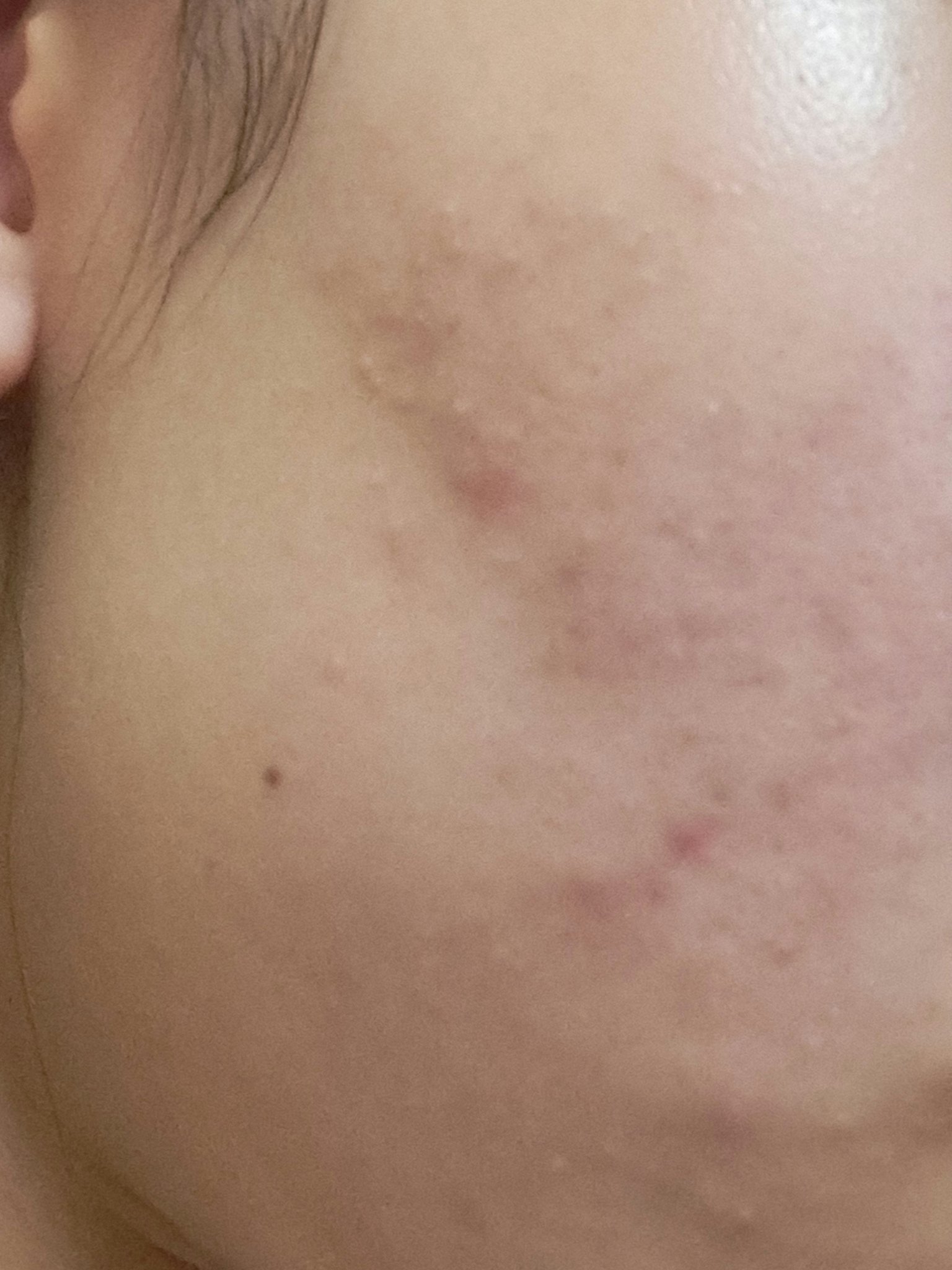 アポスティークリーム(医薬品)/アポスティー/その他を使ったクチコミ（1枚目）